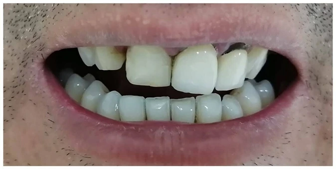 Caso 3 - Antes del tratamiento