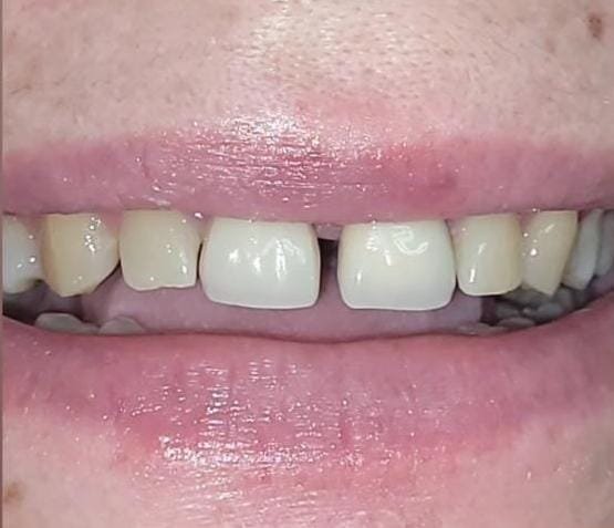 Caso 2 - Antes del tratamiento