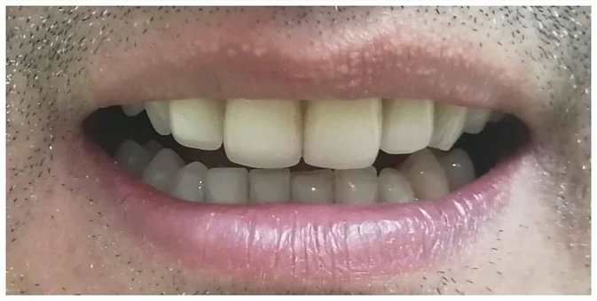 Caso 3 - Después del tratamiento