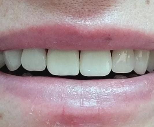 Caso 2 - Después del tratamiento